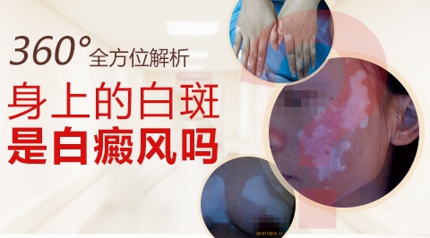 苏州瑞金白癜风研究院